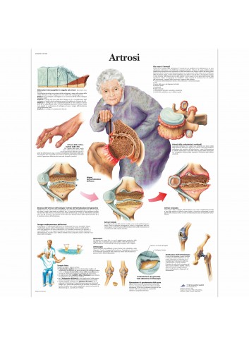 3B Scientific, tavola anatomica, Poster Artrosi (cod. VR4123UU)