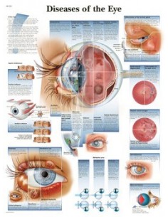 3B Scientific, tavola anatomica, Poster malattie dell'occhio (cod. VR4231UU)