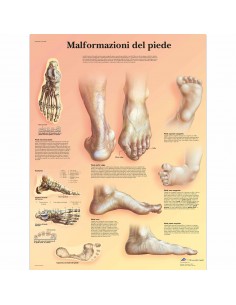 3B Scientific, tavola anatomica, Poster malformazioni di piede VR4185UU