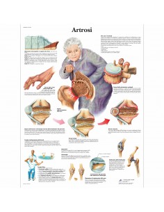 3B Scientific, tavola anatomica, Poster Artrosi (cod. VR4123UU)