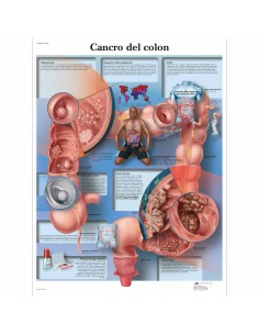 3B Scientific, tavola anatomica, Poster Cancro del Colon cod. VR4432UU