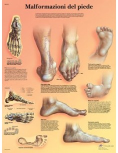 3B Scientific, tavola anatomica, Poster Malformazioni di piede (cod. VR4185L)