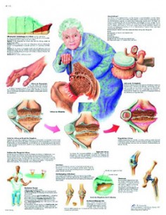 3B Scientific, tavola anatomica, Poster Artrosi  (cod. VR4123L)