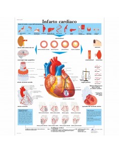 3B Scientific, tavola anatomica, Infarto Cardiaco (cod, VR4342L)
